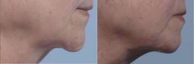 Droopy chin repair - 
	Improvement of chin ptosis by Dr. Brett Kotlus with muscle tuck.
