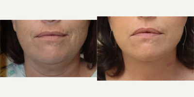35-44 year old woman treated with Laser Resurfacing - One treatment, fractional laser