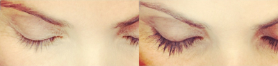 Latisse - LATISSE is a prescription treatment for hypotrichosis (inadequate or not enough lashes) to grow eyelashes longer, fuller, darker. These results are after 16 weeks.