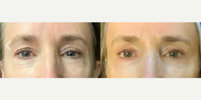 Woman treated with NeoGen Plasma - Woman treated with NeoGen Plasma
