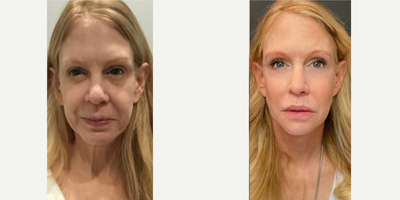 55-64 year old woman treated with Facial Fat Transfer - Before and After: Facial Fat Transfer performed by Dr. Almonte.
