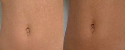 25-34 year old woman treated with Belly Button Surgery - This lady did not like her 'outie' but was happy with the overall shape of the belly button.The procedure was carried out under Local Anaesthetic and took 60 minutes. The stitches used were absorbable therefore did not require removing after the surgery.
