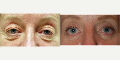 45-54 year old woman treated with Eyelid Surgery - Upper eyelid lift (blepharoplasty) and lower lid blepharoplasty through a skin incision to remove the extra skin. In addition the patient had a procedure called canthoplasty to support the lower lids , preserve the shape of the eyes and avoid lower lid retraction. Her recovery time was approximately two weeks.