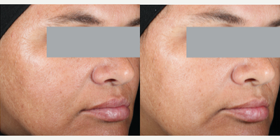 SkinCeuticals, Phloretin CF - Phloretin CF. Skin type I-IV, with mild to moderate facial pigmentation, including melasma, post-inflammatory hyperpigmentation, and hyperpigmentation. Discoloration Defense was applied to the face twice a day, in conjunction with a sunscreen. Efficacy and tolerability evaluations were conducted at baseline and at weeks 2, 4, 8, and 12. Photo provided courtesy of SkinCeuticals