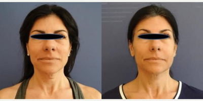 Woman treated with Fractora RF - Fractora Firm Lower Face + Neck