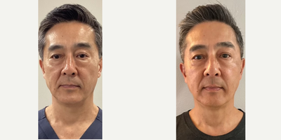 55-64 year old man treated with Emface - This is actually me prior to Emface and right after the 4th treatment. Notice cheek tightening, with slightly more volume. Naso-labial and marionette creases are less pronounced. Sub-orbital bags are also less pronounced. Maximum results are seen approximately 3 months after the least treatment. This gives the body sufficient time to naturally replenish collagen and elastin, giving a more natural and youthful appearance.