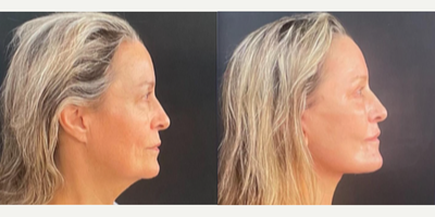 Woman treated with Neck Lift - Woman treated with Deep Plane Facelift, Neck Lift, and Brow Lift.