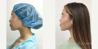25 year old woman treated with Buccal Fat Removal - 25 year old woman treated with Buccal Fat Removal