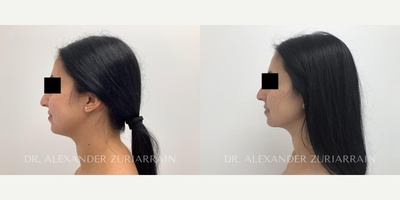 Woman treated with Chin Liposuction - Woman treated with Chin Liposuction