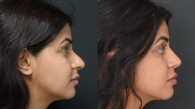 18-24 year old woman treated with Rhinoplasty - 3 Months Post-operative