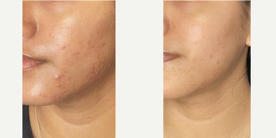 Treating Acne, Acne Scarring, and Discoloration/Hyperpigmentation - Acne and acne scarring progression using curated medical grade skincare in a comprehensive skincare routine, and a series of chemical peels