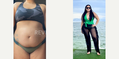 Body Transformation - Liposuction, Breast Lift - The patient carried excess weight around her abdomen, flanks, and back. She was a great candidate for liposuction 360, and the result is just what she was looking for!