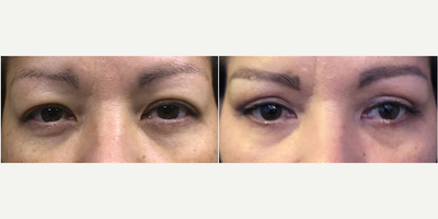 45-54 year old woman treated with Eyelid Surgery - The patient is a 45-55 year old female with a bilateral upper & lower eyelid lifts.