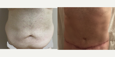 Male Tummy Tuck - Patient lost 130 pounds after having gastric surgery.  Dr. Schaffer performed a tummy tuck removing all the excess skin and fat.
