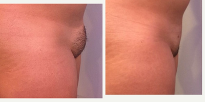 25-34 year old woman treated with Tumescent Liposuction - Female 5'3 and 130 lbs. Photo shown before and 3 months after Tumescent Liposuction of the Mons Pubis.