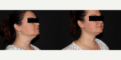 35-44 year old woman treated with FaceTite, Laser Liposuction - Cosmetic Liposuction patient who had tumescent liposuction to the chin and neck with Renuvion Skin Tightening.