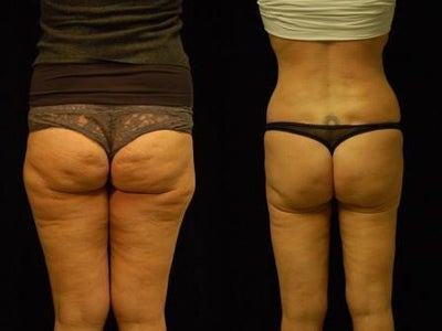 Cellulaze and Smartlipo Eleven Month Follow Up - 
	This patient in her forty's had high hopes but no expectations when she underwent Cellulaze treatmentof her buttocks and posterior upper thighs. She had Smartlipo of her hips and posterior thighs two weeks later, followed later by Smartlipo of her flanks. These photos are eleven months post Cellulaze treatment.
