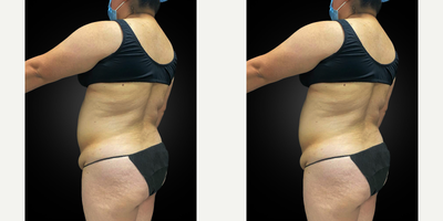 45 year old female treated with Lymphatic Massage - 45 year old female who underwent a tummy tuck with diastasis recti repair, VASER liposuction and Renuvion J Plasma skin tightening of her upper/middle/lower back, flanks, medial thighs and neck, and BBL (Brazilian Butt Lift/fat transfer to the buttocks), three months prior.