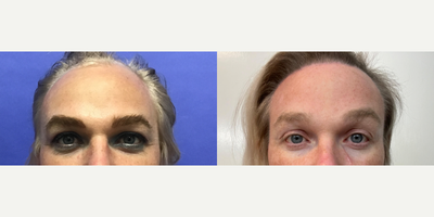 35-44 year old transgender woman treated with Brow Lift, Hair Loss Treatment, TCA Peel - 35 to 44 year-old female patient is 3 months post-op from Tissue Expander Removal and Flap Rotation and 1 year post-op from Facial Feminization surgery. Her procedures included: Placement of Tissue Expander, Forehead Lift and Orbital Bony Contouring, Septorhinoplasty (closed) with Cartilage Grafts and Weirs, Cheek Implants (small), Chin Reduction and Contour, Subnasal Lip Lift with Fat Augmentation to Lips, Medium Facelift, 1cc of Voluma Juvederm, Periorbital TCA Peel and Removal of two moles on face, Remove Tissue Expander and Rotate Flap.