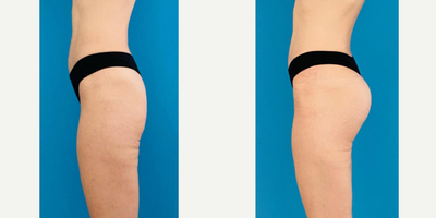 35-44 year old woman treated with Butt Implants - Butt augmentation with implants