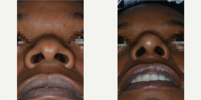 25-34 year old woman treated with African American Rhinoplasty - Before and after a rhinoplasty procedure