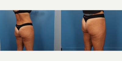 45-54 year old woman treated with Aveli - Aveli is a minimally invasive, FDA-cleared treatment for cellulite that targets the fibrous bands (septa) beneath the skin that cause dimpling. It works by precisely releasing these bands, allowing the skin to smooth out naturally. Aveli is known for providing long-lasting results with minimal downtime, and it offers a significant reduction in cellulite appearance after just one treatment.