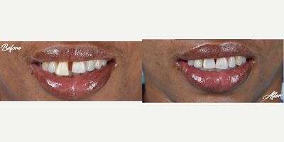 35-44 year old woman treated with Dental Implants, Dental Bone Graft, Dental Crown - This patient presented bone loss and due to this she presented mobility due to the absence of bone support. He was indicated for dental extraction, placement of a dental implant and bone graft.