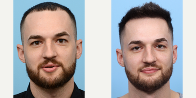25-34 year old man treated with FUE Hair Transplant, Hair Transplant, Hair Loss Treatment, PRP for Hair Loss - Dr. Wise was able to help a 34-year-old patient fill in his receding hairline and increase hair density with a successful FUE hair transplant procedure and one session of PRP therapy. After one year, the patient has achieved significant results.