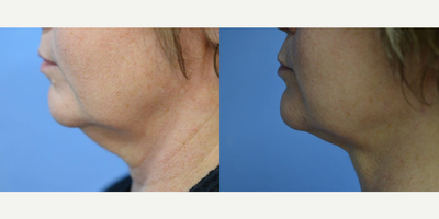 54 year old woman treated with FaceTite - 54 year old woman treated with FaceTite