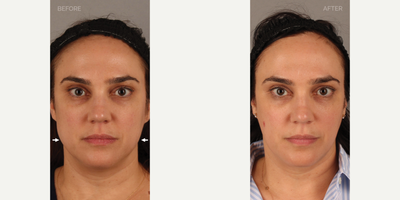 Non-Surgical Jawline Slimming (Masseter Botox) - 46-year-old female who presented with a history of nighttime grinding and clenching, leading to significant pain and discomfort. She noted that this also correlated with enlarged masseter (chewing) muscles, making her jaw look wider. She is shown 6 weeks after masseter Botox, to treat her symptoms and narrow her jawline.