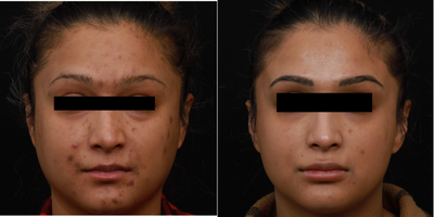 35-44 year old woman treated with Jessner Peel, Skin Rejuvenation - Patient treated for Adult Acne and Post Inflammmatory Hyperpigmenation due to acneic condition. The patient had a series of Q-Switched toning and peels to control acne and to even out the skin tone by reducing pigmented skin.