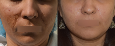 25-34 year old woman treated with Scar Removal - Surgical and non-surgical treatments for scar revision.