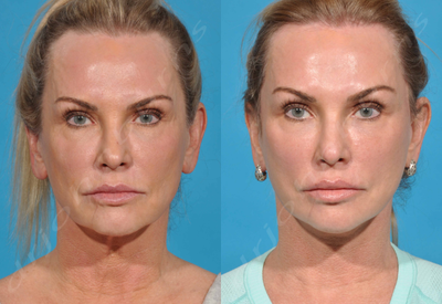 55-64 year old woman treated with Skin Rejuvenation - Lift and Fill Facelift: Face and Neck Lift with Fat Transfer to Face and Skin Resurfacing