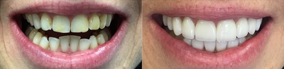 50 year old woman treated with Dental Crown - 50 year old woman treated with Dental Crown. To achieve this we did upper 10 and 6 lower veneers.