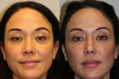 Woman treated with Skin Rejuvenation - Woman treated with Skin Rejuvenation through laser resurfacing as well as lower blepharoplasty with fat transfer. Patient complain about her lower eyes looked tired and she felt she had bags under her eyes and was looking for a long term and more permanent solution that doesn't require ongoing treatments. The fat transfer allowed for subtle contouring to the cheek, face and tear trough to avoid hollowing.