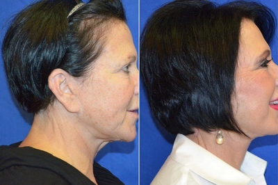 Woman on her 60's treated with Skin Rejuvenation - Woman on her 60's treated with Skin Rejuvenation