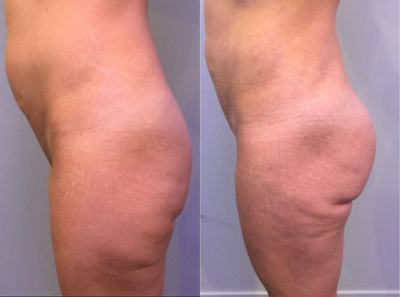 35-44 year old woman treated with Butt Augmentation - Female with 3 previous pregnancies, 5' 2 and 130 lbs. Pictured before and 4 months after Butt Augmentation.