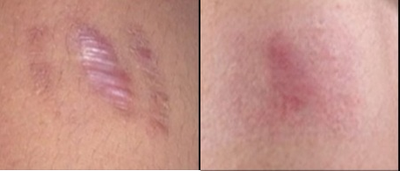 18-24 year old woman treated with Scar Removal - Fractional Co2 laser scar revision before and after 2 treatments. Procedure was covered through insurance.