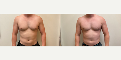 Man treated with Gynecomastia Surgery - Man treated with Gynecomastia Surgery. 10 weeks post-op