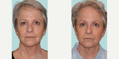 Woman treated with Sculptra, Dysport, RHA Collection Fillers - Our beautiful patient received a combination of treatments for a refreshed and youthful appearance. Heres what we did:Sculptra to the cheeks: Added volume and stimulated collagen for a natural lift.Dysport to the upper and lower face: Smoothed dynamic wrinkles, giving a rejuvenated look.RHA 2 to the lips and lip border: Enhanced the lips and softened fine lines around the mouth for a flawless finish.The results speak for themselves! Shes thrilled with her enhanced, natural look, and we couldnt be happier for her.