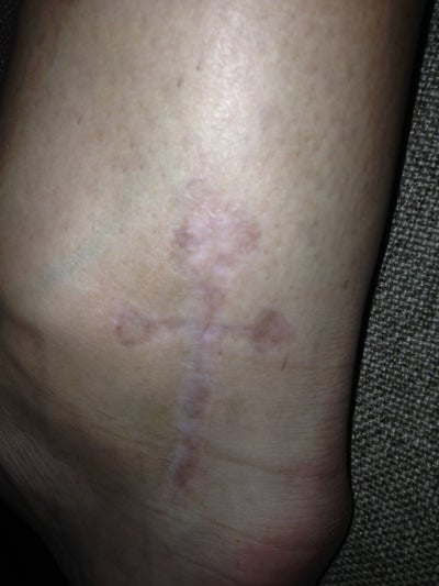 Should I continue with my laser tattoo removal treatments ...