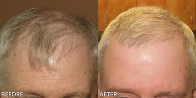 Man treated with ARTAS Robotic Hair Transplant, Hair Transplant - Man treated with Hair Transplant, ARTAS Robotic Hair Transplant