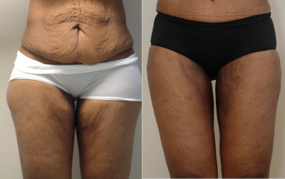 35-44 year old woman treated with Thigh Lift - Thigh Lift and Abdominoplasty