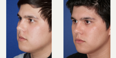 25-34 year old man treated with Buccal Fat Removal - Buccal Fat Pad Removal
