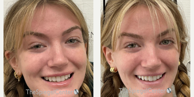 18-24 year old woman treated with Xeomin - Botulinum