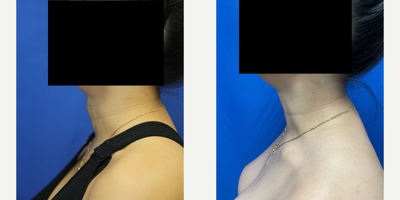 25-34 year old transgender woman treated with Transgender Facial Feminization Surgery - This is a transgender patient (male to female) in her early 30s who came to Dr. Katzen for a tracheal shave (also known as shaving of the Adams apple). Many transgender patients come in for this procedure when wanting a more feminine look. Dr. Katzen makes a tiny horizontal incision in the fold of the neck to then reduce the trachea. This patient was very happy with her results and smooth neck. She paired this procedure with breast augmentation with silicone implants. Those photos can be found in the breast augmentation section of the website.