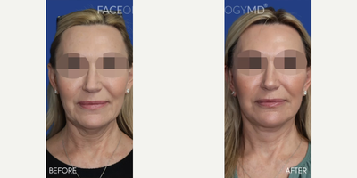 Woman treated with Facelift, CO2 Laser - Woman treated with Facelift, CO2 Laser