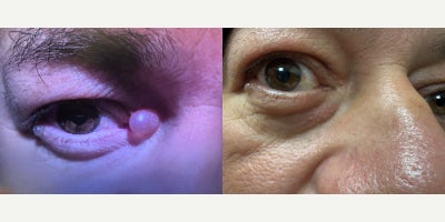 55-64 year old man treated with Mole Removal - excision of lesion nasal