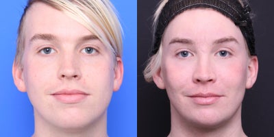 35-44 year old transgender woman treated with Facial Feminization Surgery - AFG to tear troughs, cheeks, NLF, temples; rhinoplasty; upper lip augmentation , cheek augmentation with implants, submental liposuction