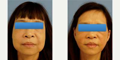 Woman treated with Silicone Injection Removal - Woman treated with Silicone Injection Removal as well as Facelift. Patient had liquid silicone as an injectable filler to face years ago and suffered from its side effects.